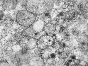 F, 36y. | chemodectoma - neck